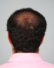 Before Hair Transplant&nbsp;2 Sessions (Areas)